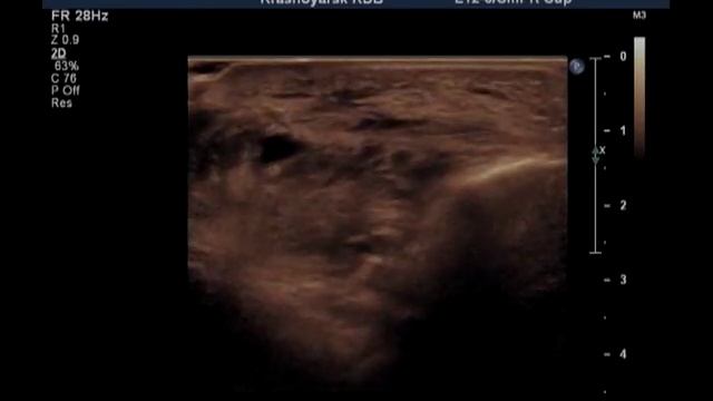 Ложная аневризма плечевой артерии смотреть онлайн