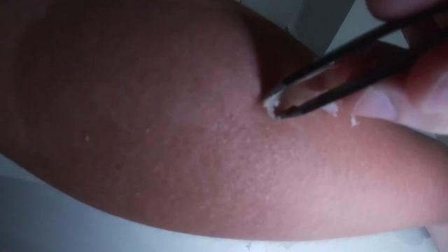 Peel off human skin after sunburn 晒爆皮 撕人皮L201 смотреть онлайн