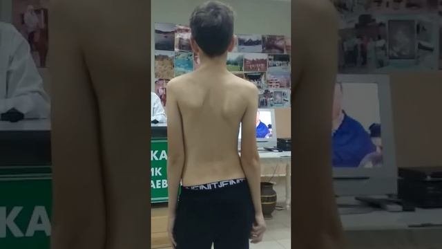 Исправление сколиоза - Шабаев Эмиль, 11 лет. Целитель Рафик Миннекаев