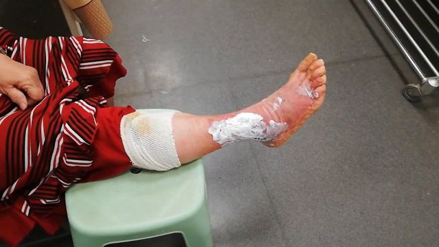 Ожог 2й степени открытым огнём смотреть онлайн