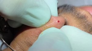 Tons of blackheads. 17 minutes of extractions.Blackheads, whiteheads,milia. Face and ears. MrPopZit