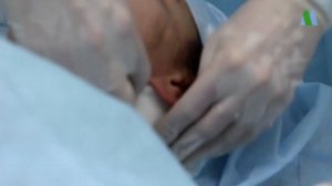 Нити Аптос. Нитевая подтяжка