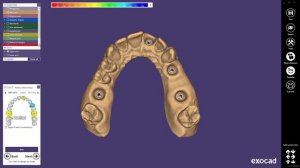 exocad Quick Guide: Implant Model