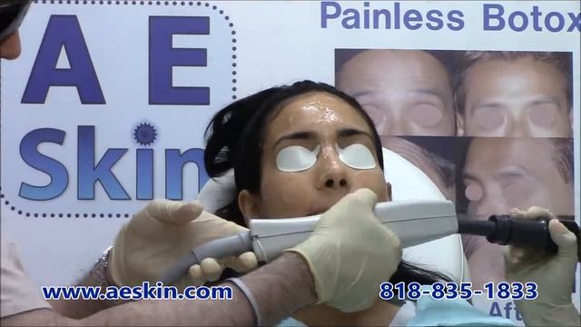 Forever Young BBL IPL Photofacial Demonstration 11 - A E Skin - Encino, CA - 818-835-1833 смотреть онлайн
