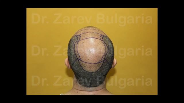 Dr. Zarev hair transplant 10620 grafts / Д-р Зарев трансплантация на коса 10620 присадки смотреть онлайн