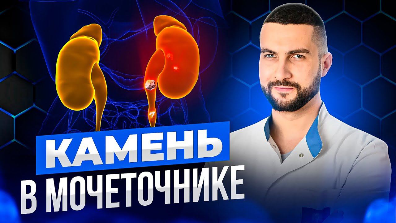 Что происходит после удаления камня мочеточника?