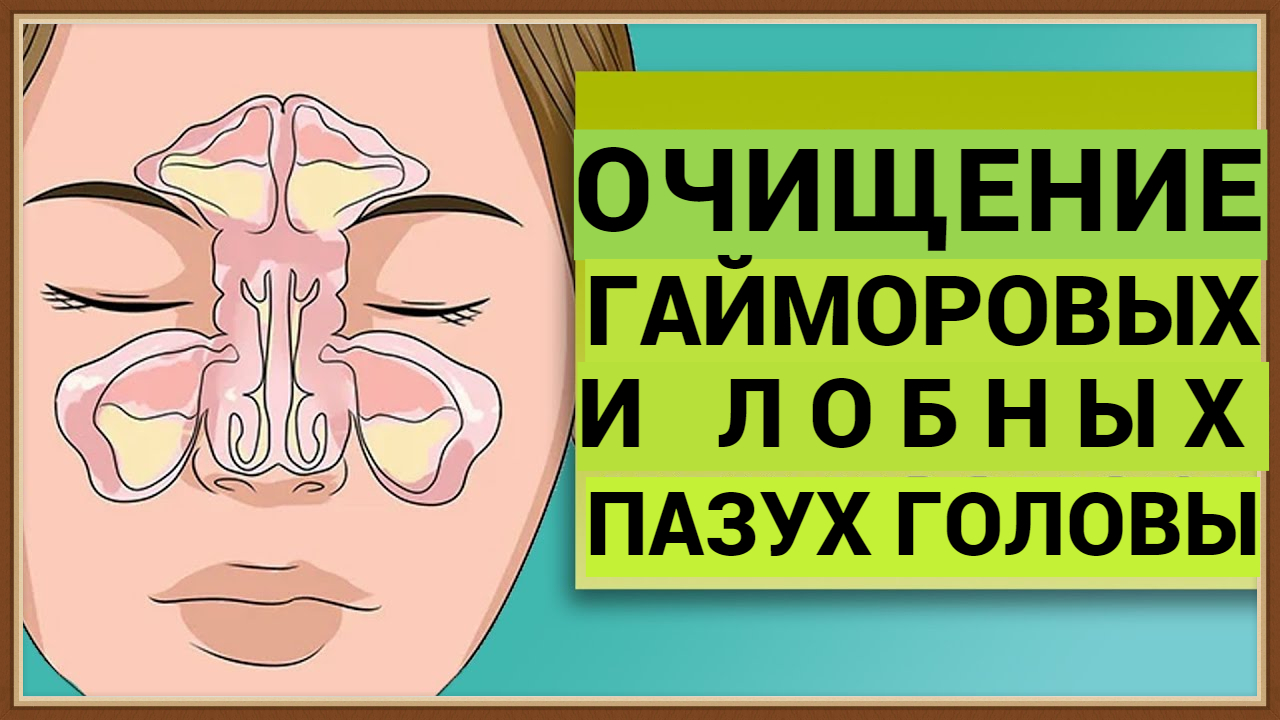 ЧИСТКА ГАЙМОРОВЫХ И ЛОБНЫХ ПАЗУХ ГОЛОВЫ