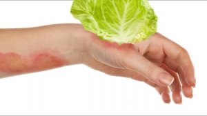 Как лечить ожог/6 простых домашних средств.