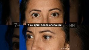 Верхняя и нижняя блефаропластика. Реабилитация за 7 дней. Работа Соломона абрамяна.