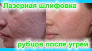 Лазерная шлифовка рубцов после угрей
