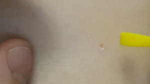 Как удалить клеща у человека ?Смотрите в моём видео обзор инструментом для удаления клещей!