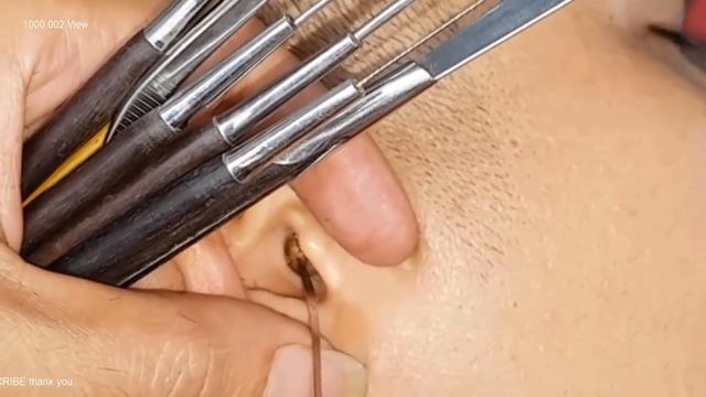 Убираем прищ . Доктор ильнус.... смотреть онлайн