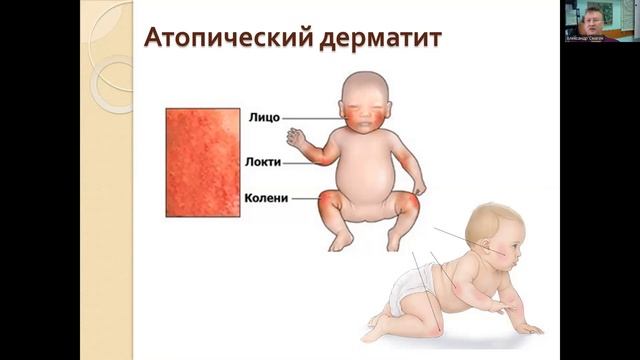Атопический дерматит и другие аллергические состояния у детей раннего возраста смотреть онлайн