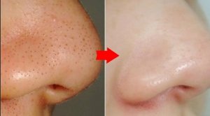 Супер-средство, действительно убирает черные точки.