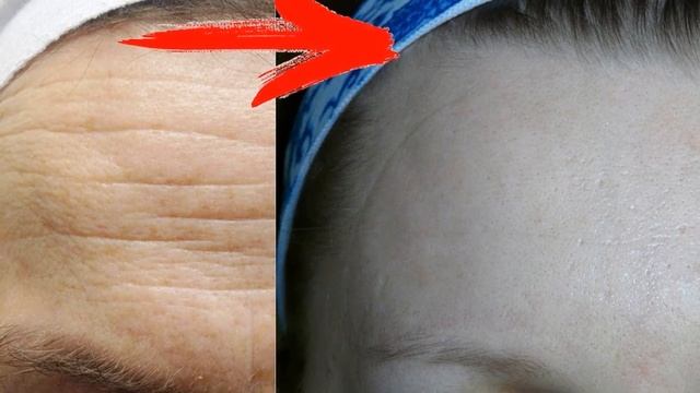 Как убрать глубокие морщины