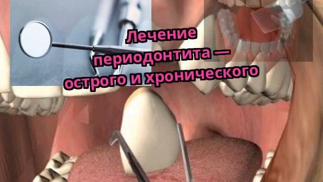 Лечение периодонтита — острого и хронического