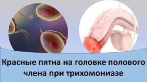 Красные пятна на головке полового члена при трихомониазе