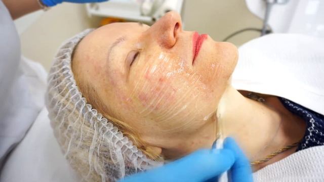 Процедура SMAS - лифтинга на аппарате ULTRAFORMER