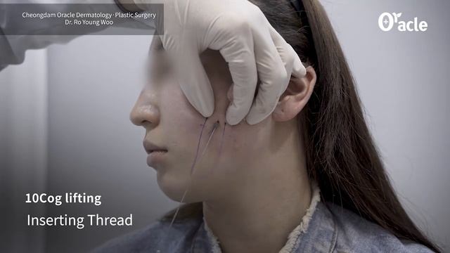 텐코그 12cm 리프팅 (10cog 12cm thread lifting) смотреть онлайн