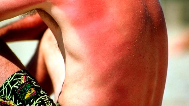 ПОЧЕМУ ЗАГАР «ЦЕПЛЯЕТСЯ» НЕ КО ВСЕМ И КАК СОЛНЦЕ ВЛИЯЕТ НА КОЖУ смотреть онлайн