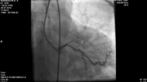 коронарография -хроническая окклюзия ПМЖВ- chronic coronary occlusion of the LAD