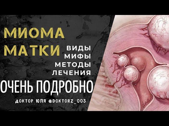 Миома матки - виды миом, способы лечения миомы матки
