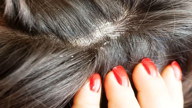 Как избавиться от перхоти в домашних условиях смотреть онлайн