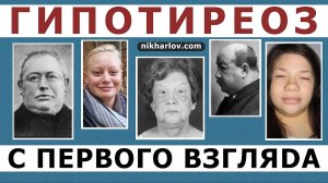 ?Как выглядит пациент с ГипоТиреозом отёки, полулунное лицо, выпадение бровей, облысение, микседема