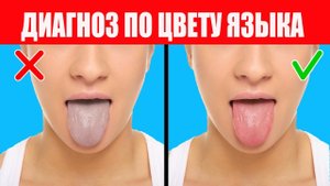 Белый налет на языке. Диагноз заболеваний по языку