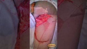 Некоторые этапы пластики пролежня области седалищного бугра.