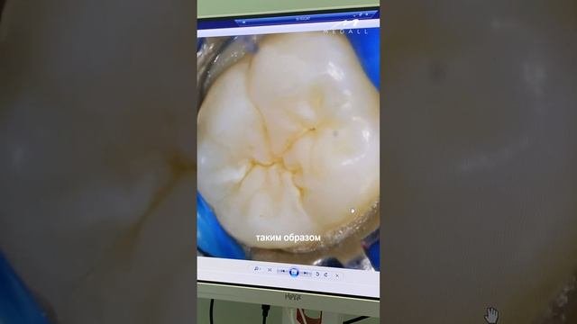 ГЕРМЕТИЗАЦИЯ ФИССУР #детскаястоматология