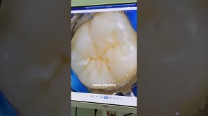 ГЕРМЕТИЗАЦИЯ ФИССУР #детскаястоматология