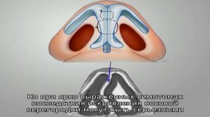 Искривление носовой перегородки: опасные последствия