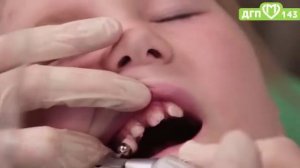 Реминерализация зубов