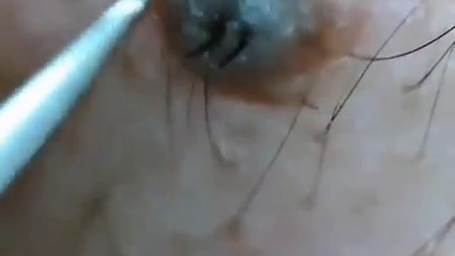 Вросший волос  в прыще смотреть онлайн