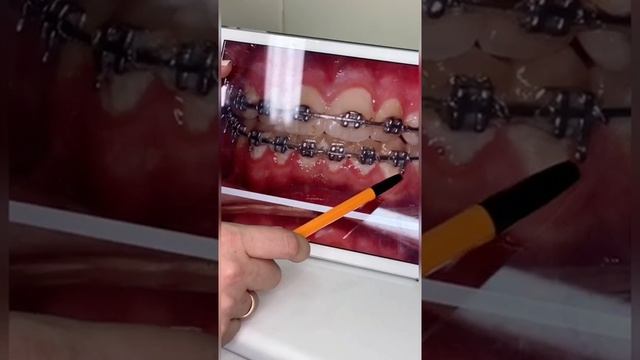 Брекеты и профгигиена.