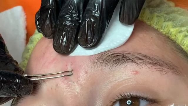 Blackheads extraction | pimples popping | satisfying video | subscribe please ? смотреть онлайн