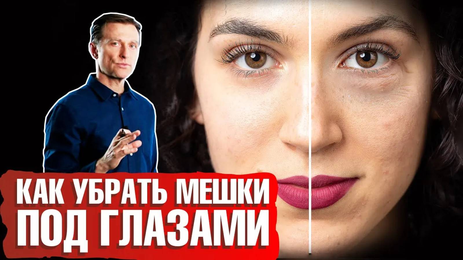 Мешки под глазами: как убрать? Какая причина отека под глазами? 👁