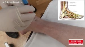 Блокада икроножного нерва Техника блокады лодыжки Sural Nerve Block