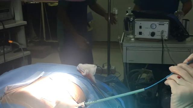 PCNL case 2 ( stone in the left renal pelvis) Prof.Mian Naushad Ali/Dr.Usman Afridi