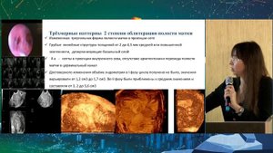 43  УЗ диагностика синдрома Ашермана   Есипова Ирина Андреевна