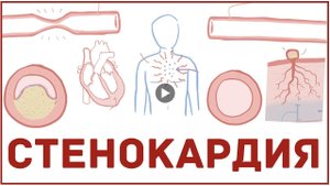 СТЕНОКАРДИЯ - ПРИЧИНЫ СИМПТОМЫ ЛЕЧЕНИЕ.mp4