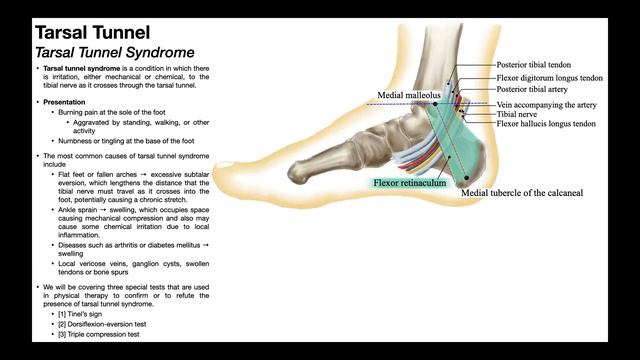 Tarsal Tunnel Syndrome | Clinical Anatomy & Presentation смотреть онлайн