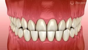 Мезиальный прикус