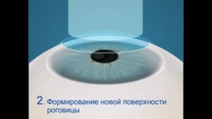 Коррекция зрения ФРК (фоторефракционная кератэктомия)