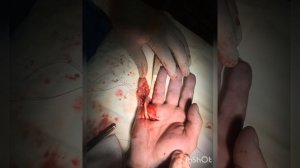 шов сухожилий сгибателей пальцев кисти