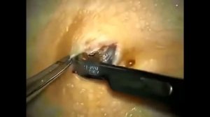 Большая черная точка, удаление