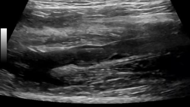 флотирующий тромб МБВ смотреть онлайн