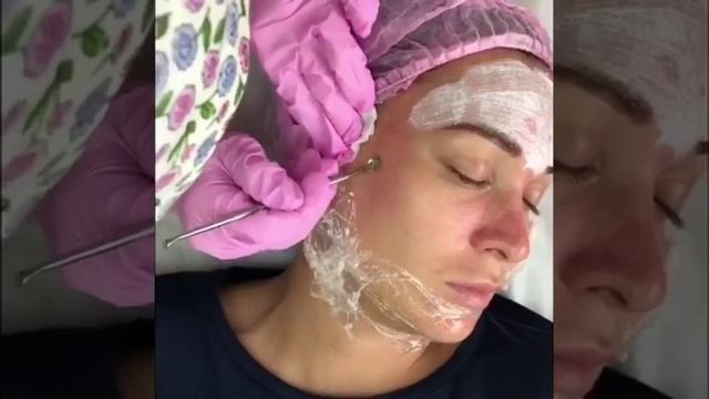 Чистка лица в клинике "Яблоко" смотреть онлайн