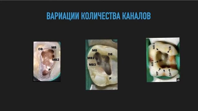 Как легко запомнить количество корней и каналов у моляров смотреть онлайн